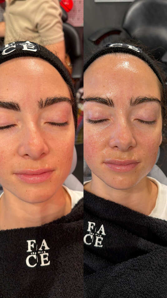Resultado real de clienta de Face Training Donostia: antes y después