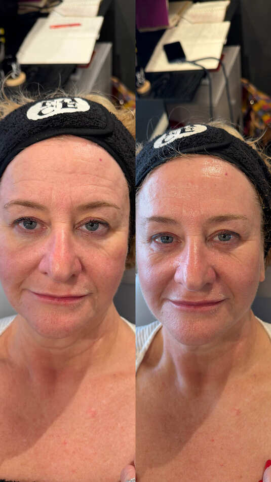 Resultado real de clienta de Face Training Donostia: antes y después