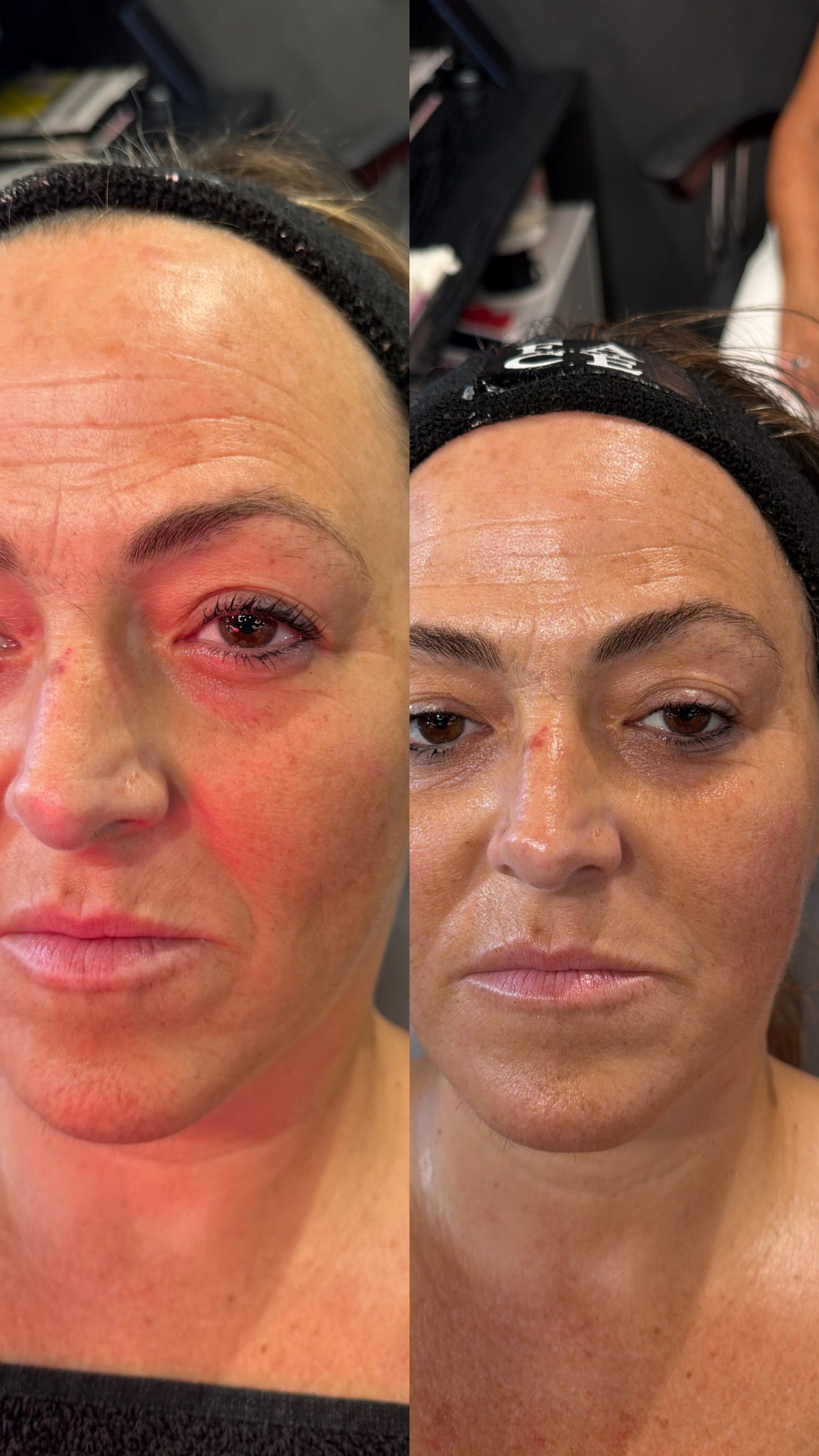 Resultado real de clienta de Face Training Donostia: antes y después